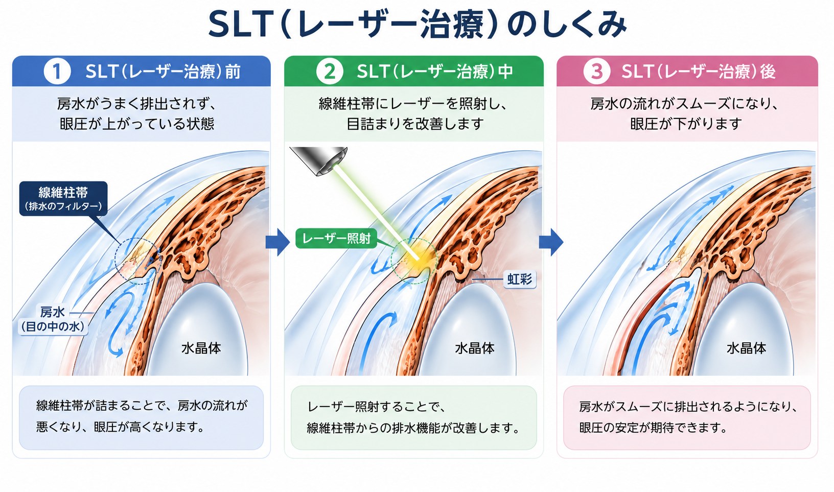 SLTの仕組みの説明画像