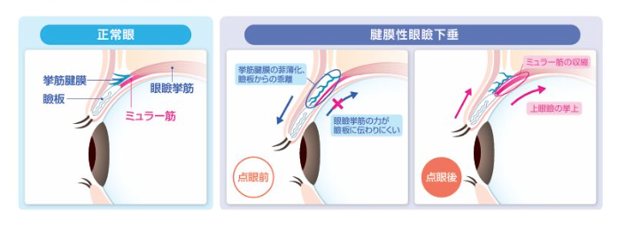 眼瞼下垂点眼治療の説明図